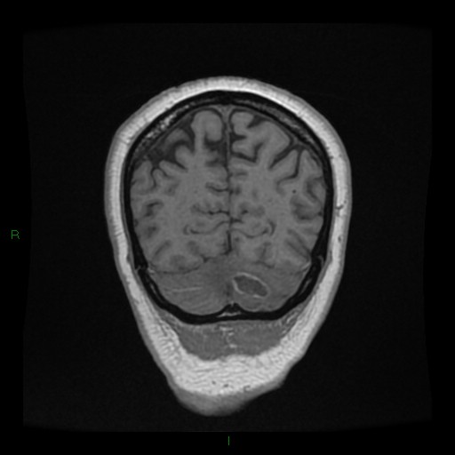 Cerebellar abscess (Radiopaedia 78135-90678 Coronal T1 C+ 138).jpg