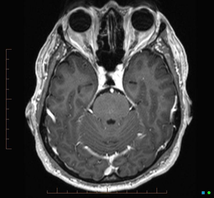 Cerebellar gangliocytoma (Radiopaedia 65377-74422 Axial T1 C+ 38).jpg
