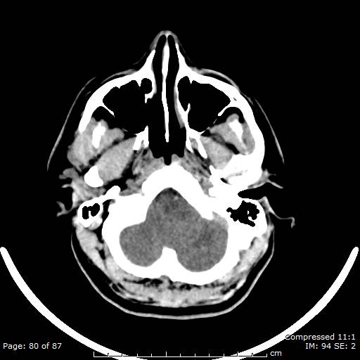 Cerebellar hemangioblastoma (Radiopaedia 52360-58258 Axial non-contrast 80).jpg