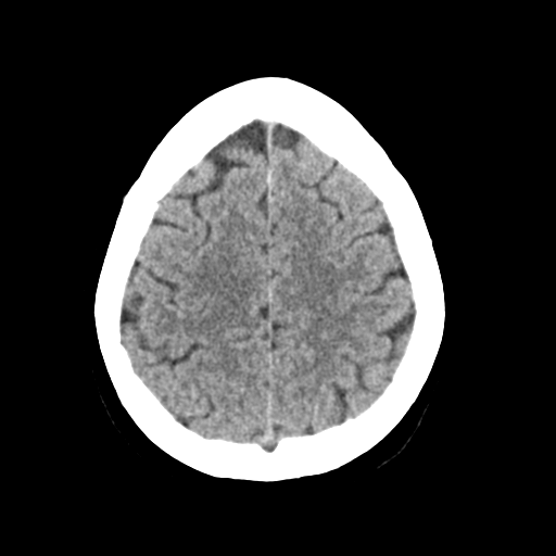 File:Cerebellar metastasis (Radiopaedia 54578-60812 Axial non-contrast 40).png