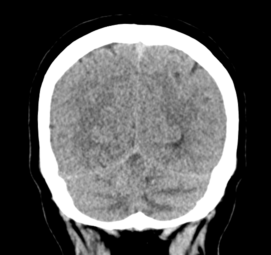 Cerebellar metastasis (Radiopaedia 54578-60812 Coronal non-contrast 48).png