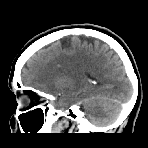 File:Cerebellar metastasis (cystic appearance) (Radiopaedia 41395-44258 F 34).png