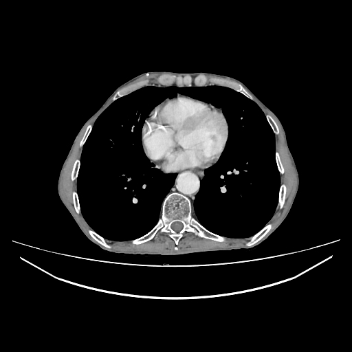 Cerebellar metastasis - lung tumor (Radiopaedia 69317-79150 A 24).jpg