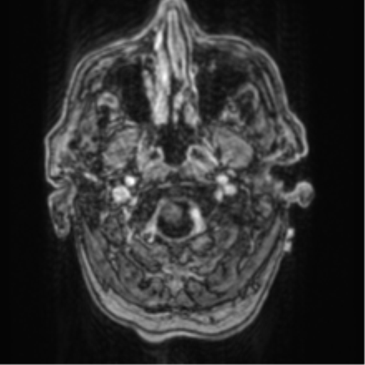 File:Cerebellar metastasis from lung adenocarcinoma (Radiopaedia 86690-102829 Axial T1 C+ 9).png