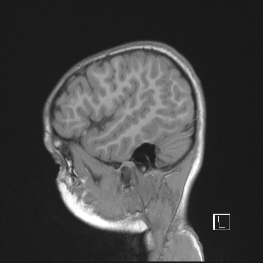 Cerebellar stroke (Radiopaedia 32202-33150 Sagittal T1 C+ 9).png