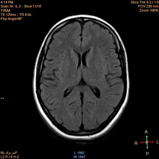 File:Cerebellopontine angle meningioma (Radiopaedia 22488-22525 Axial FLAIR 10).jpg