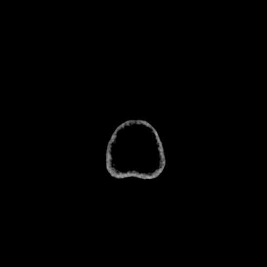 Cerebellopontine angle meningioma (Radiopaedia 53561-59592 Axial non-contrast 74).jpg