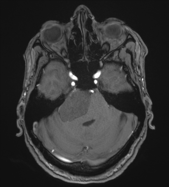Cerebellopontine angle meningioma (Radiopaedia 72983-83680 Axial MRA 32).jpg