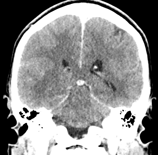 Cerebral abscess (Radiopaedia 60342-68008 Coronal C+ delayed 41).png
