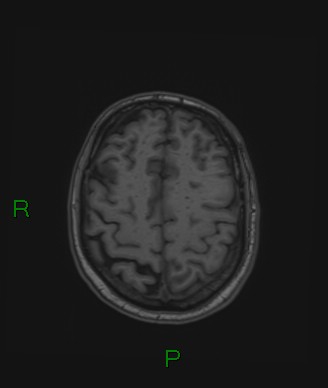 Cerebral abscess and subdural empyema (Radiopaedia 84436-99779 Axial T1 24).jpg