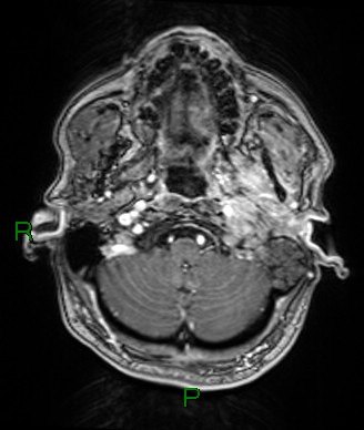 Cerebral abscess and subdural empyema (Radiopaedia 84436-99779 Axial T1 C+ 75).jpg