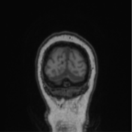 Cerebral abscess from pulmonary arteriovenous malformation (Radiopaedia 86275-102291 Coronal T1 11).png