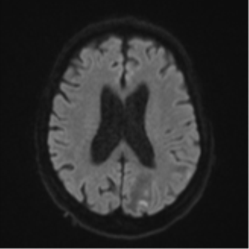Cerebral abscesses- medically managed (Radiopaedia 45183-49179 Axial DWI 46).png