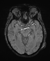 File:Cerebral amyloid angiopathy-related inflammation (Radiopaedia 74836-85849 Axial SWI 30).jpg