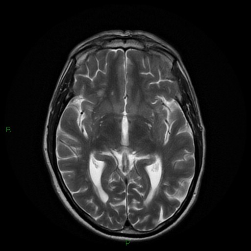 File:Cerebral amyloid angiopathy (Radiopaedia 77506-89664 Axial T2 14).jpg