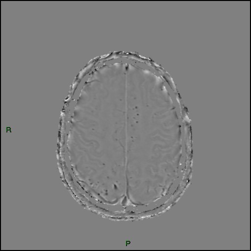Cerebral amyloid angiopathy (Radiopaedia 77506-89664 H 79).jpg
