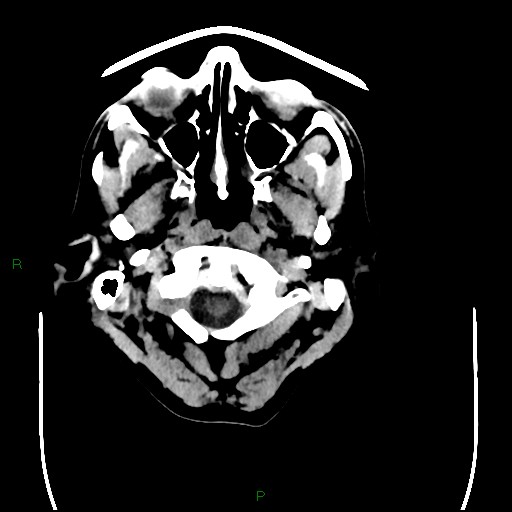 Cerebral amyloid angiopathy (Radiopaedia 77506-89665 Axial non-contrast 3).jpg