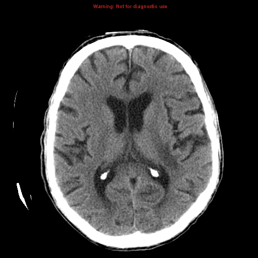 File:Cerebral and orbital tuberculomas (Radiopaedia 13308-13310 Axial non-contrast 16).jpg