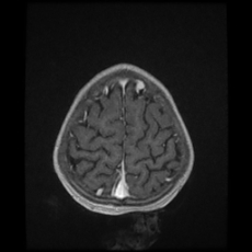 Cerebral and spinal tuberculosis (Radiopaedia 90489-107837 Axial T1 C+ 167).jpg