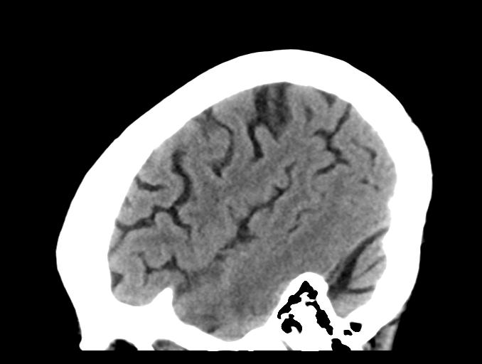 File:Cerebral aneurysm with rupture (Radiopaedia 29933-30457 B 7).jpg