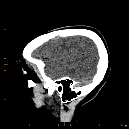 Cerebral arteriovenous malformation (AVM) (Radiopaedia 78162-90706 A 14).jpg
