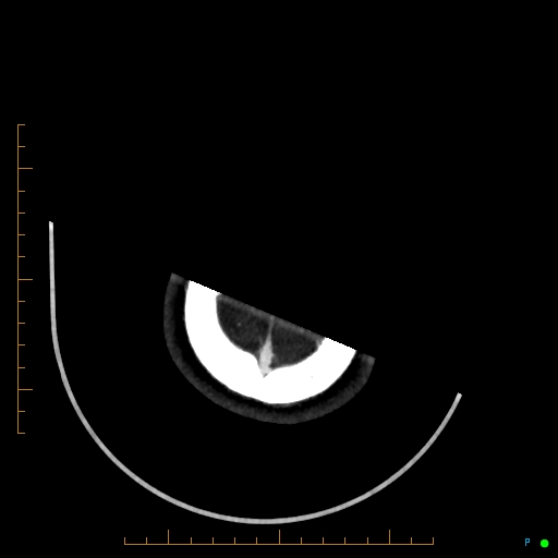 Cerebral arteriovenous malformation (AVM) (Radiopaedia 78162-90706 Axial CTA 250).jpg