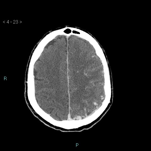 File:Cerebral arteriovenous malformation (Radiopaedia 40528-43125 Axial C+ delayed 23).jpg