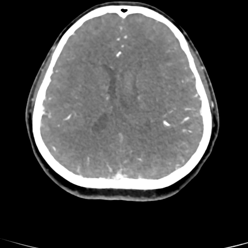 Cerebral arteriovenous malformation (Radiopaedia 73830-84645 B 41).jpg