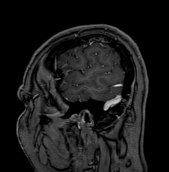 Cerebral arteriovenous malformation (Radiopaedia 74411-85746 Sagittal T1 C+ 9).jpg