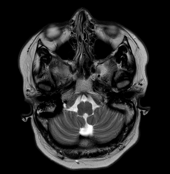 File:Cerebral arteriovenous malformation (Radiopaedia 74411-89343 Axial T2 5).jpg