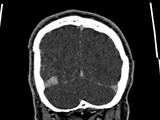Cerebral arteriovenous malformation (Radiopaedia 78188-90746 Coronal C+ delayed 109).jpg