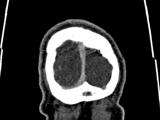 Cerebral arteriovenous malformation (Radiopaedia 78188-90746 Coronal C+ delayed 123).jpg