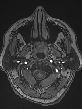 Cerebral arteriovenous malformation (Radiopaedia 84015-99245 Axial TOF 15).jpg