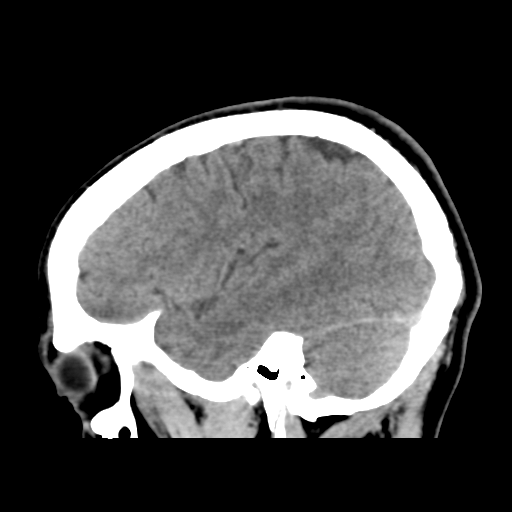 File:Cerebral arteriovenous malformation (Spetzler-Martin grade 2) (Radiopaedia 41262-44076 A 19).png