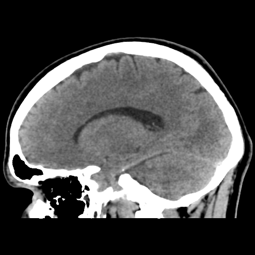 Cerebral arteriovenous malformation (Spetzler-Martin grade 2) (Radiopaedia 41262-44076 A 38).png
