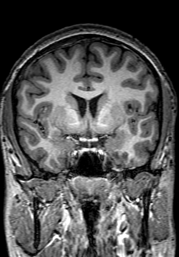 File:Cerebral arteriovenous malformation at posterior body of corpus callosum (Radiopaedia 74111-84925 Coronal T1 132).jpg