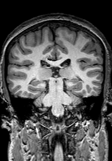 Cerebral arteriovenous malformation at posterior body of corpus callosum (Radiopaedia 74111-84925 Coronal T1 204).jpg