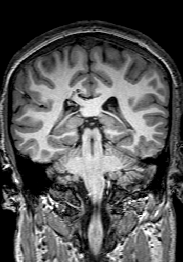 Cerebral arteriovenous malformation at posterior body of corpus callosum (Radiopaedia 74111-84925 Coronal T1 213).jpg
