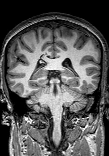 File:Cerebral arteriovenous malformation at posterior body of corpus callosum (Radiopaedia 74111-84925 Coronal T1 217).jpg