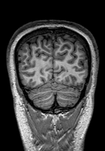 File:Cerebral arteriovenous malformation at posterior body of corpus callosum (Radiopaedia 74111-84925 Coronal T1 303).jpg