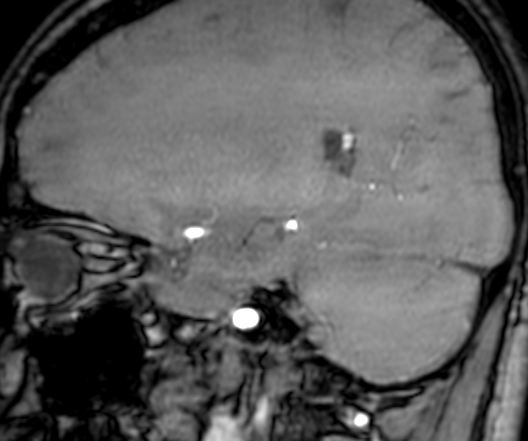 Cerebral arteriovenous malformation at posterior body of corpus callosum (Radiopaedia 74111-84925 J 123).jpg