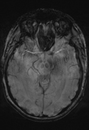 File:Cerebral cavernoma and development venous anomaly (Radiopaedia 37603-39482 Axial SWI 17).png