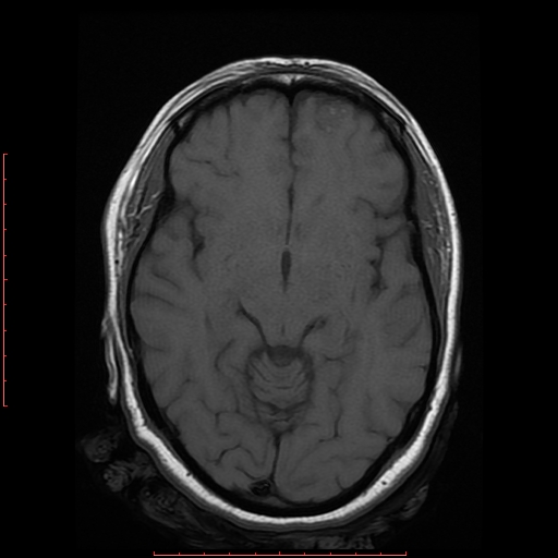 File:Cerebral cavernous malformation (Radiopaedia 26177-26306 Axial T1 10).jpg