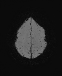 Cerebral cavernous venous malformation (Radiopaedia 70008-80021 Axial SWI 57).jpg