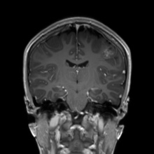 File:Cerebral cavernous venous malformation (Radiopaedia 70008-80021 Coronal T1 C+ 30).jpg
