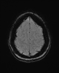 Cerebral cavernous venous malformation (Radiopaedia 70008-80021 I 64).jpg