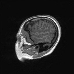 File:Cerebral cavernous venous malformation (Radiopaedia 70008-80021 Sagittal T1 10).jpg