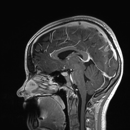 Cerebral cavernous venous malformation (Radiopaedia 70008-80021 Sagittal T1 C+ 37).jpg