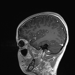 Cerebral cavernous venous malformation (Radiopaedia 70008-80021 Sagittal T1 C+ 54).jpg