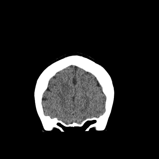 Cerebral cavernous venous malformation (Radiopaedia 70008-80022 non-contrast 10).jpg